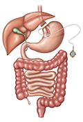 The Adjustable Gastric Band wraps around the upper part of the stomach, dividing it into a small upper pouch and a larger lower stomach.