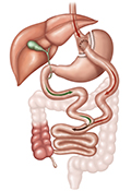 During a gastric bypass, the surgeon creates a small stomach pouch using a stapling device and attaches a section of the small intestine directly to the pouch.